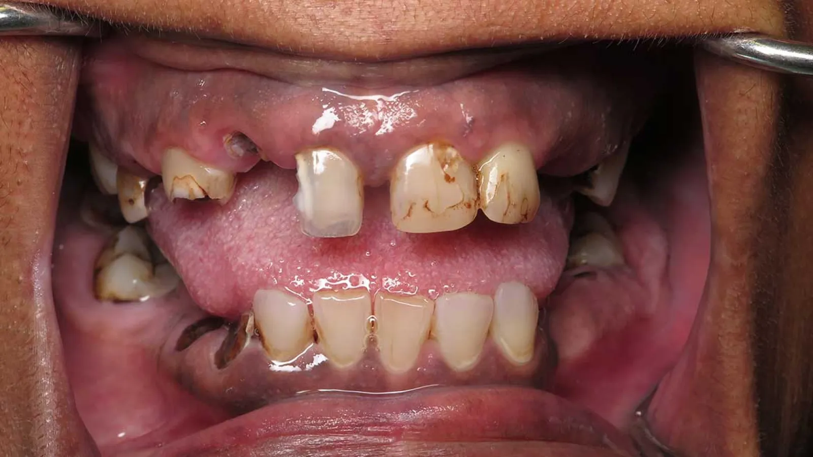 Close-up of severely decayed and missing teeth with visible dental plaque and gum inflammation.