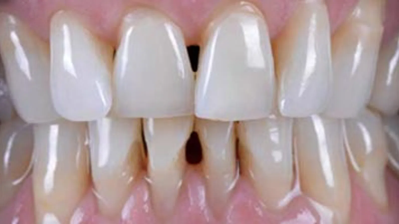 Close-up of human teeth showing dental crowding and misalignment in upper and lower jaws.