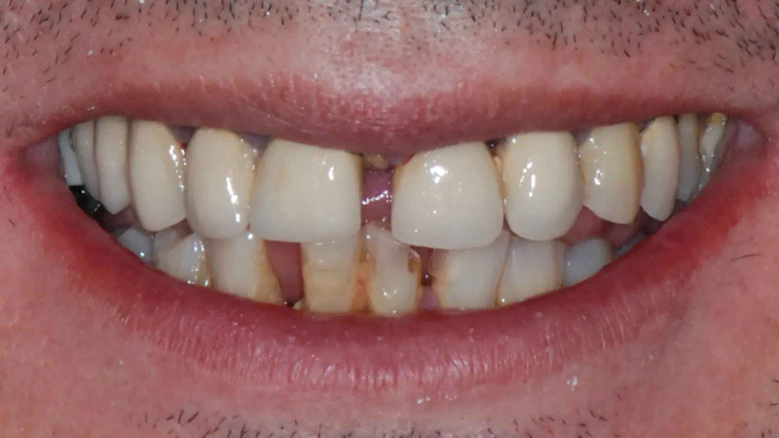 Close-up of a mouth with stained, misaligned, and missing teeth showing poor dental hygiene.