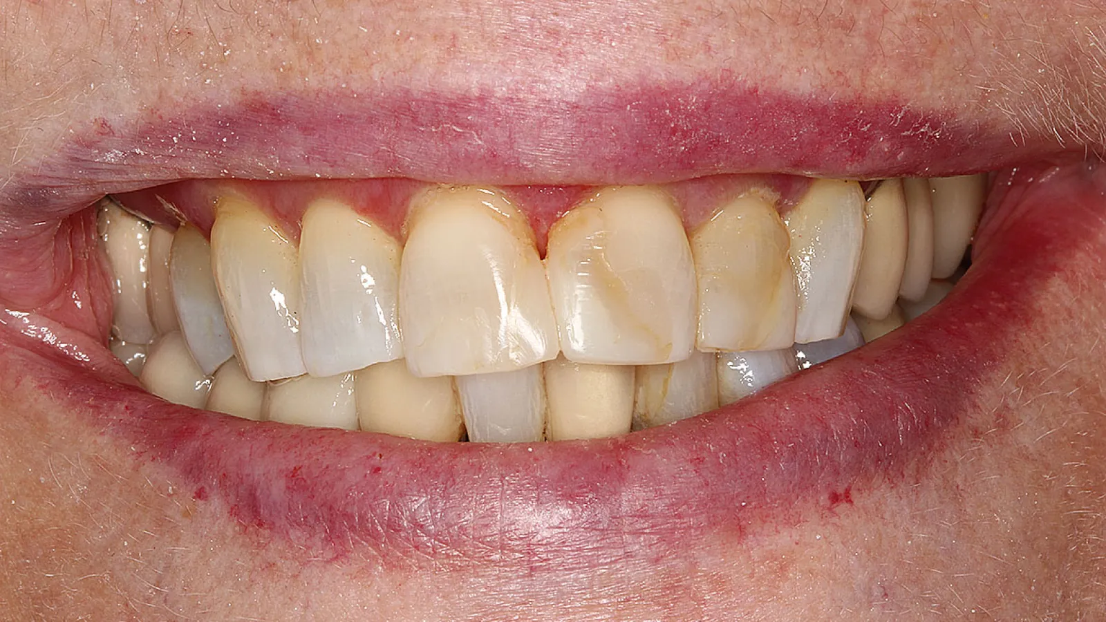 Close-up of a smiling mouth showing stained and uneven upper teeth with visible plaque and gum redness.
