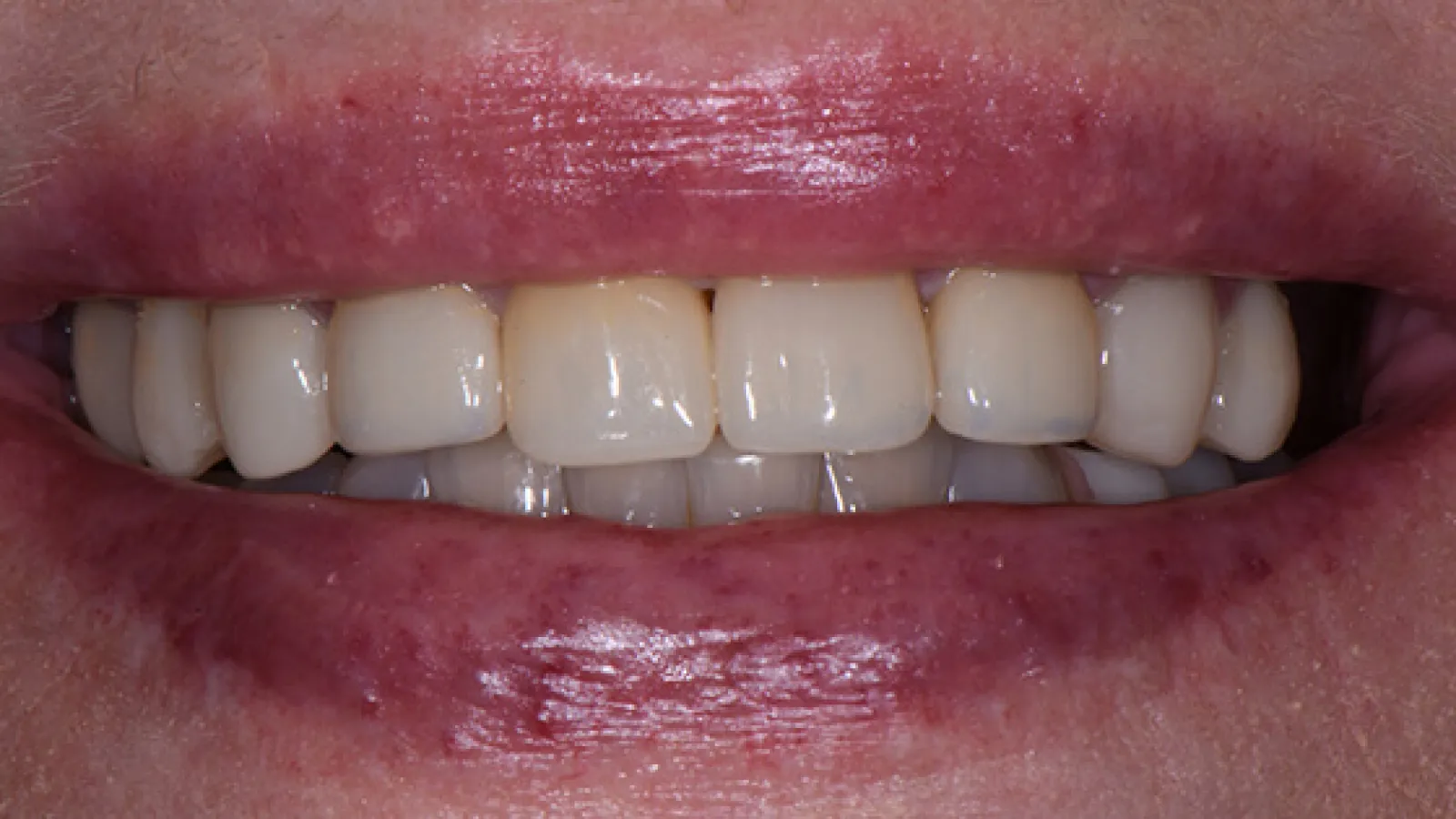 Close-up of a smile showing healthy, well-aligned teeth with natural pink lips.