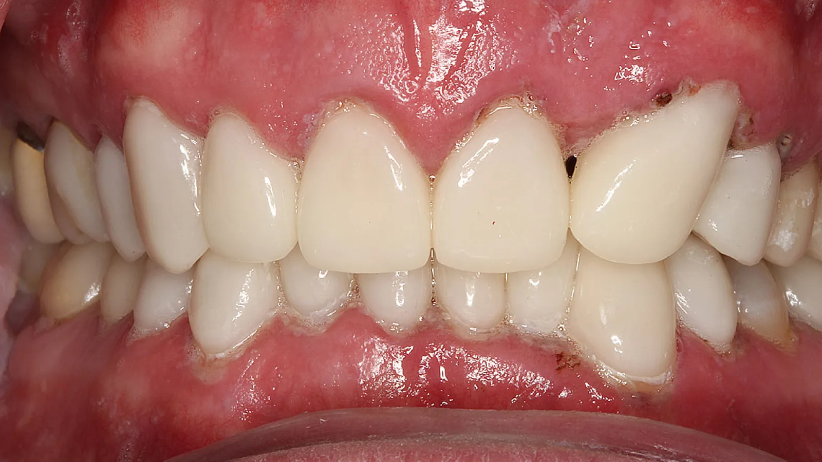 Close-up of human teeth with visible dental plaque and gum inflammation showing poor oral hygiene.