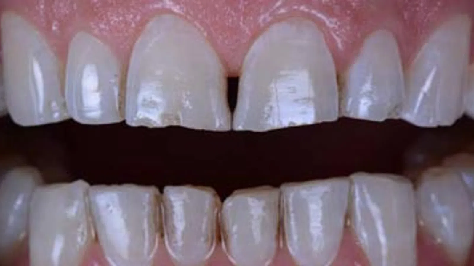 Close-up of upper and lower front teeth showing chipped and uneven edges with visible dental wear and damage.