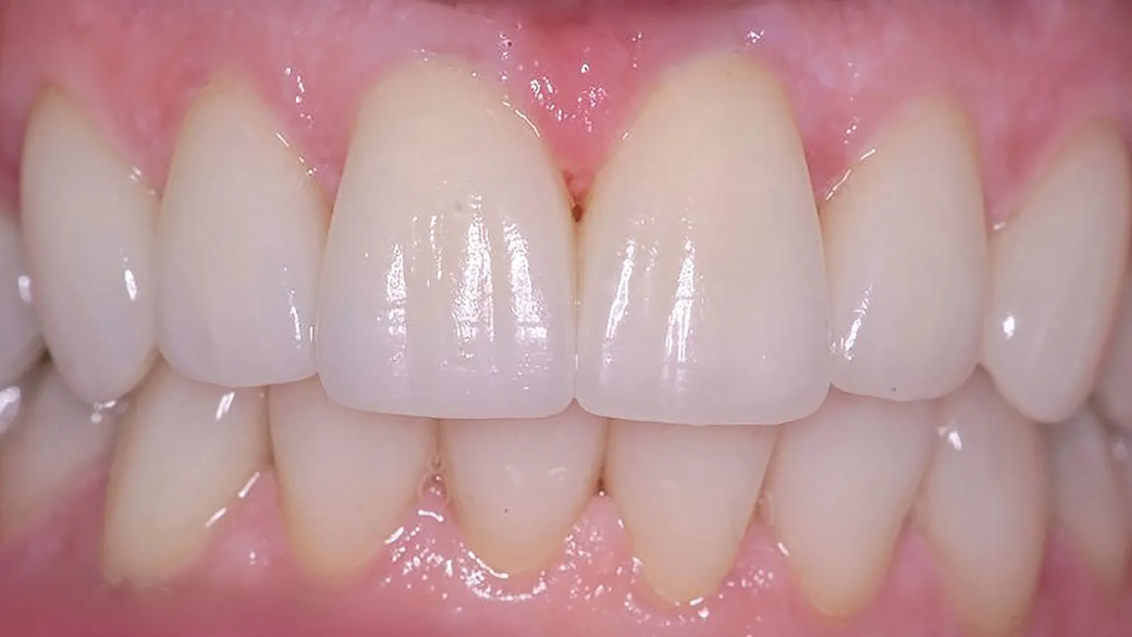 Close-up of a bright, healthy smile with straight, white teeth and pink gums.