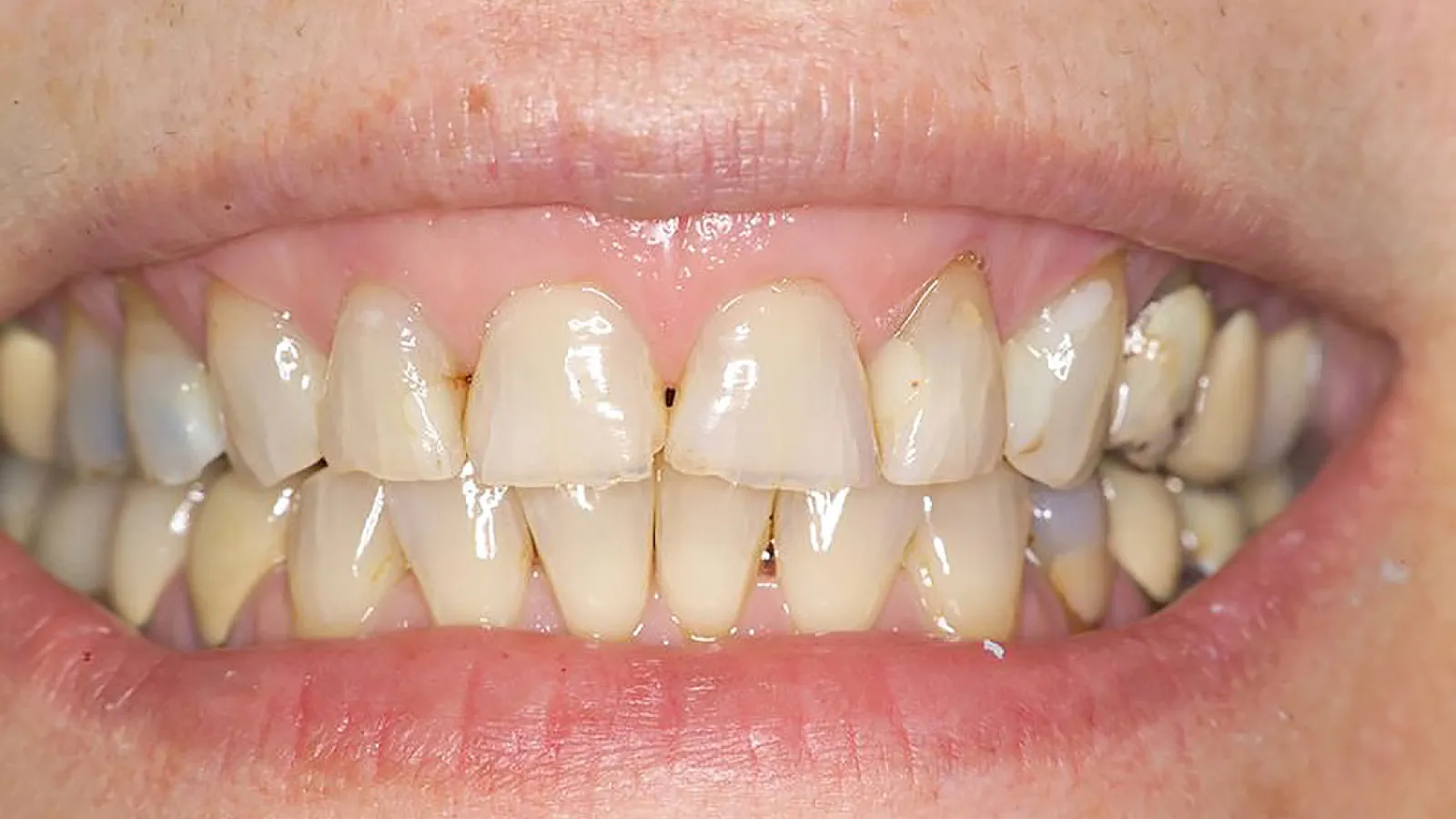 Close-up of a smile showcasing natural teeth with slight discoloration and alignment imperfections.