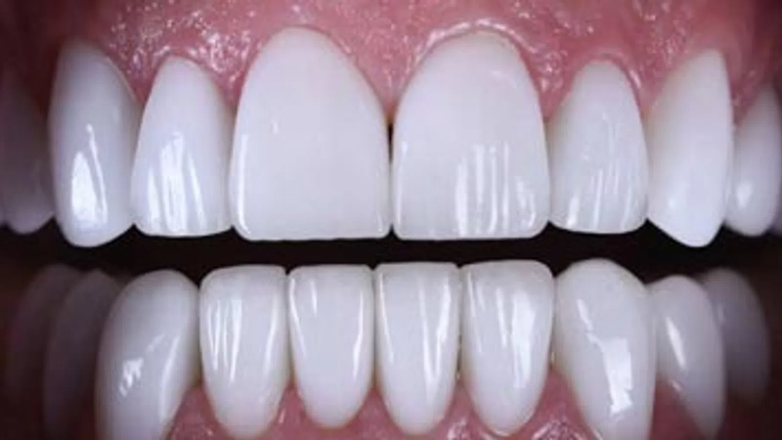 Close-up of a healthy set of white upper and lower human teeth with gums visible in a smile.