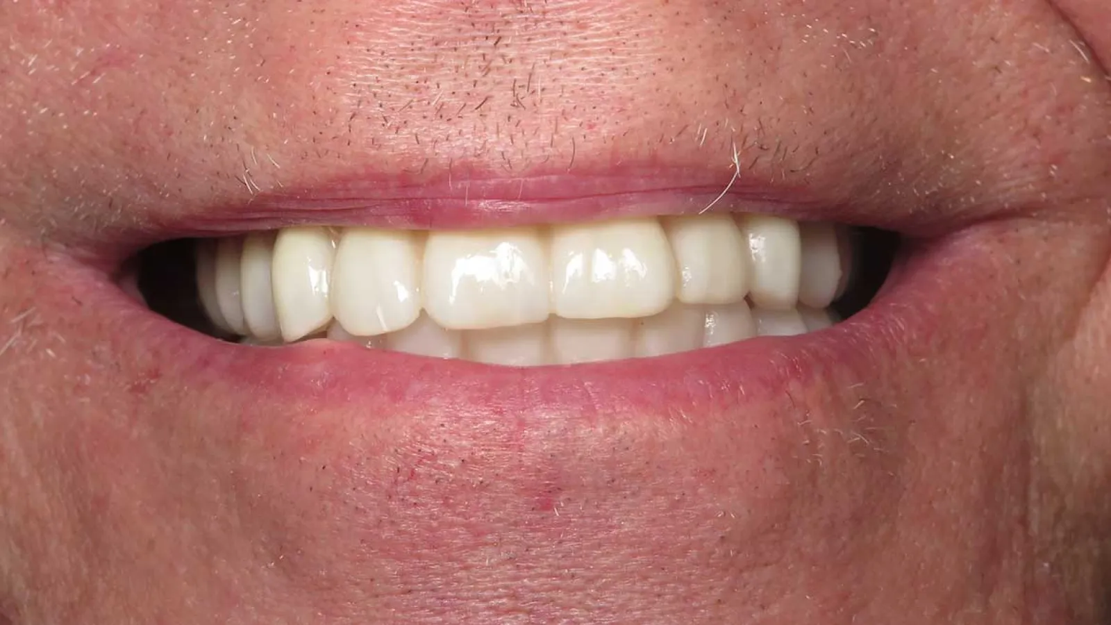 Close-up of a smiling mouth showing clean white teeth and natural lip texture.