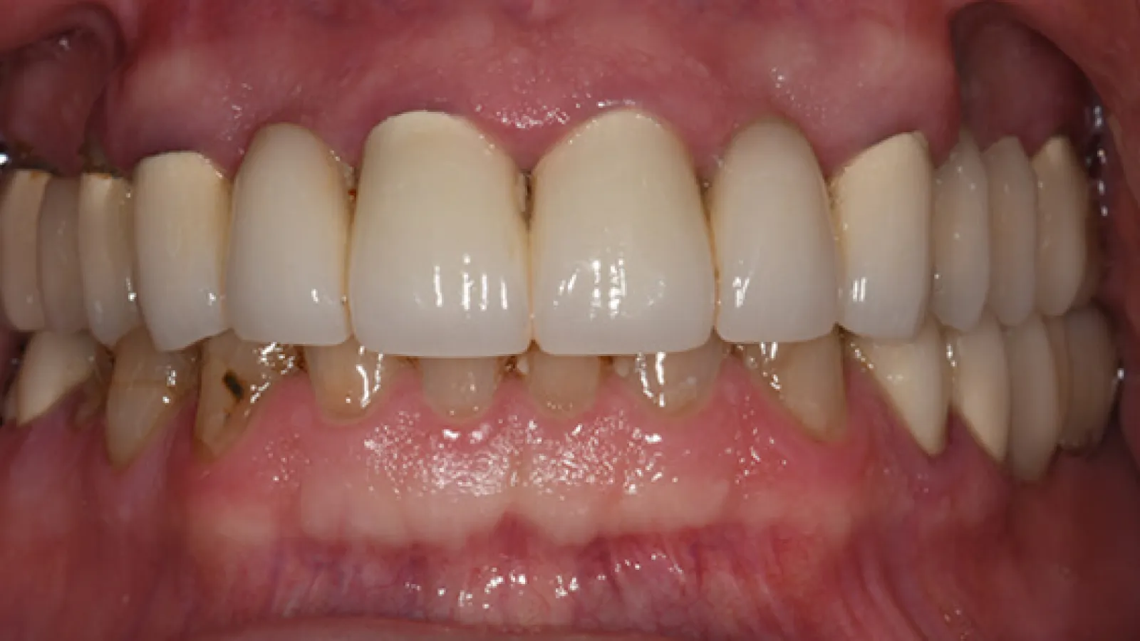Close-up of human teeth showing dental crowns on upper front teeth and natural lower teeth with gums visible