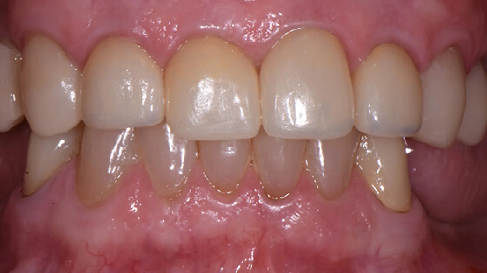 Close-up of upper and lower teeth with slight wear and natural staining on gums and enamel.