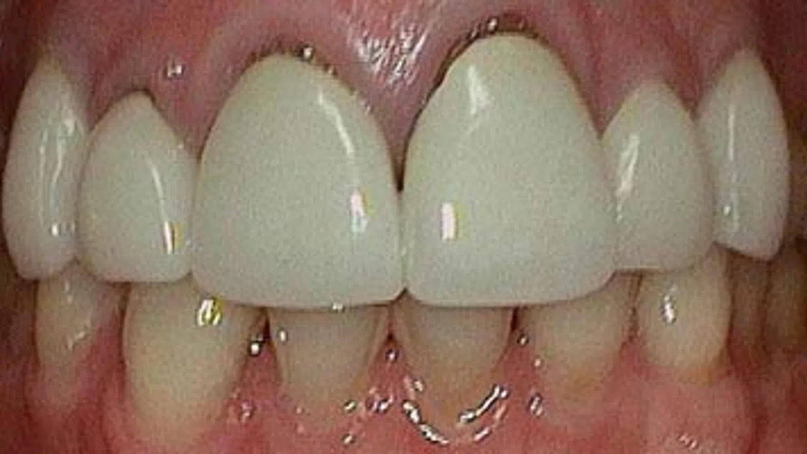Close-up of teeth showing dental crowns and natural teeth with gums visible in the mouth.