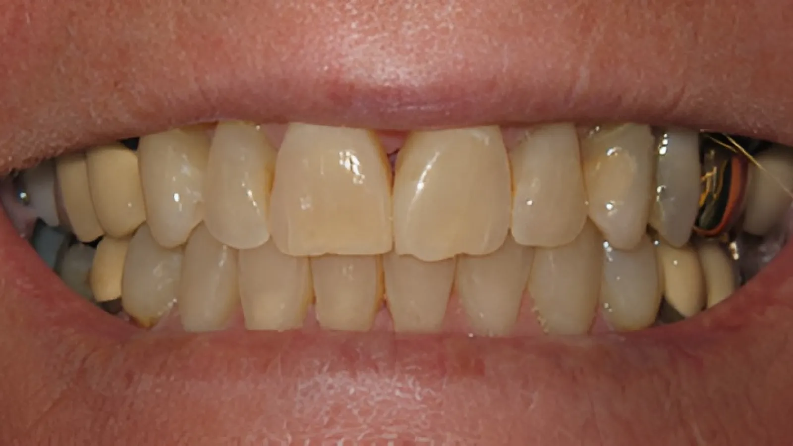 Close-up of a smile showing natural and dental crown teeth with visible discoloration and wear.
