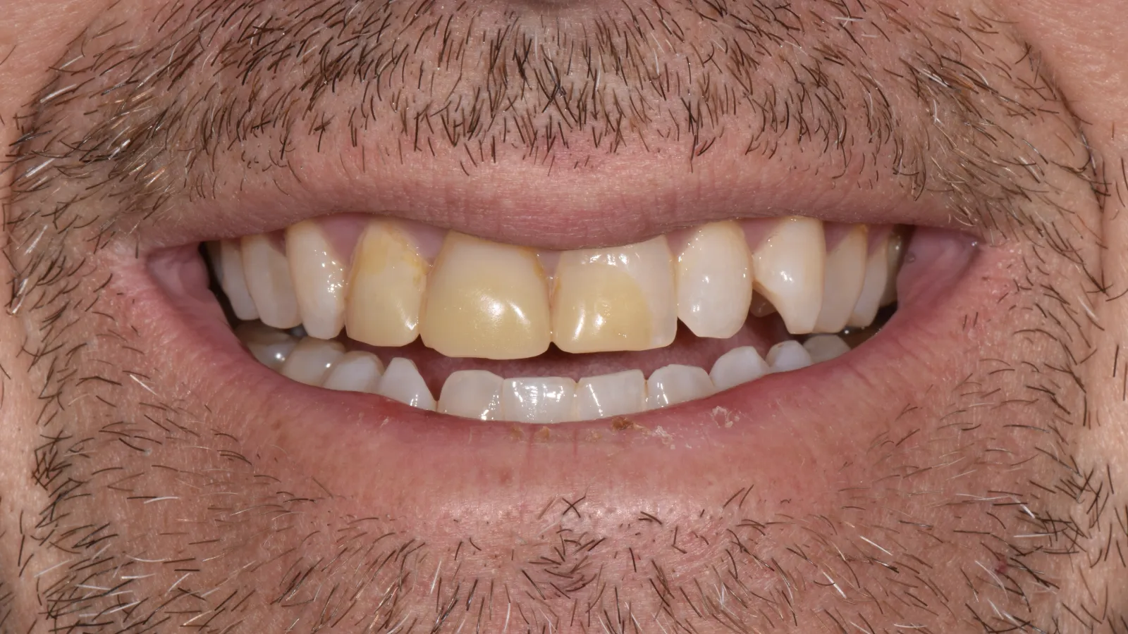 Close-up of a man's smile showing stained, uneven, and yellowed teeth with facial hair around the mouth.
