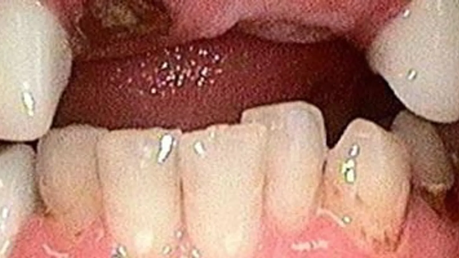 Close-up of teeth showing discoloration and plaque buildup on lower front teeth with open mouth.