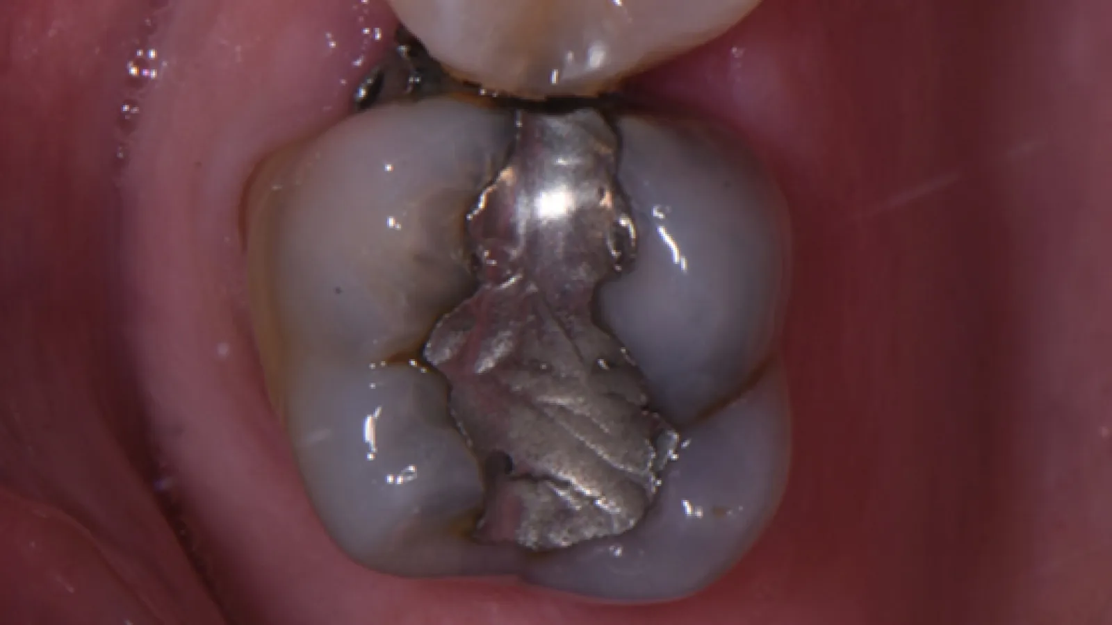 Close-up of a molar tooth with a silver dental filling inside the mouth.