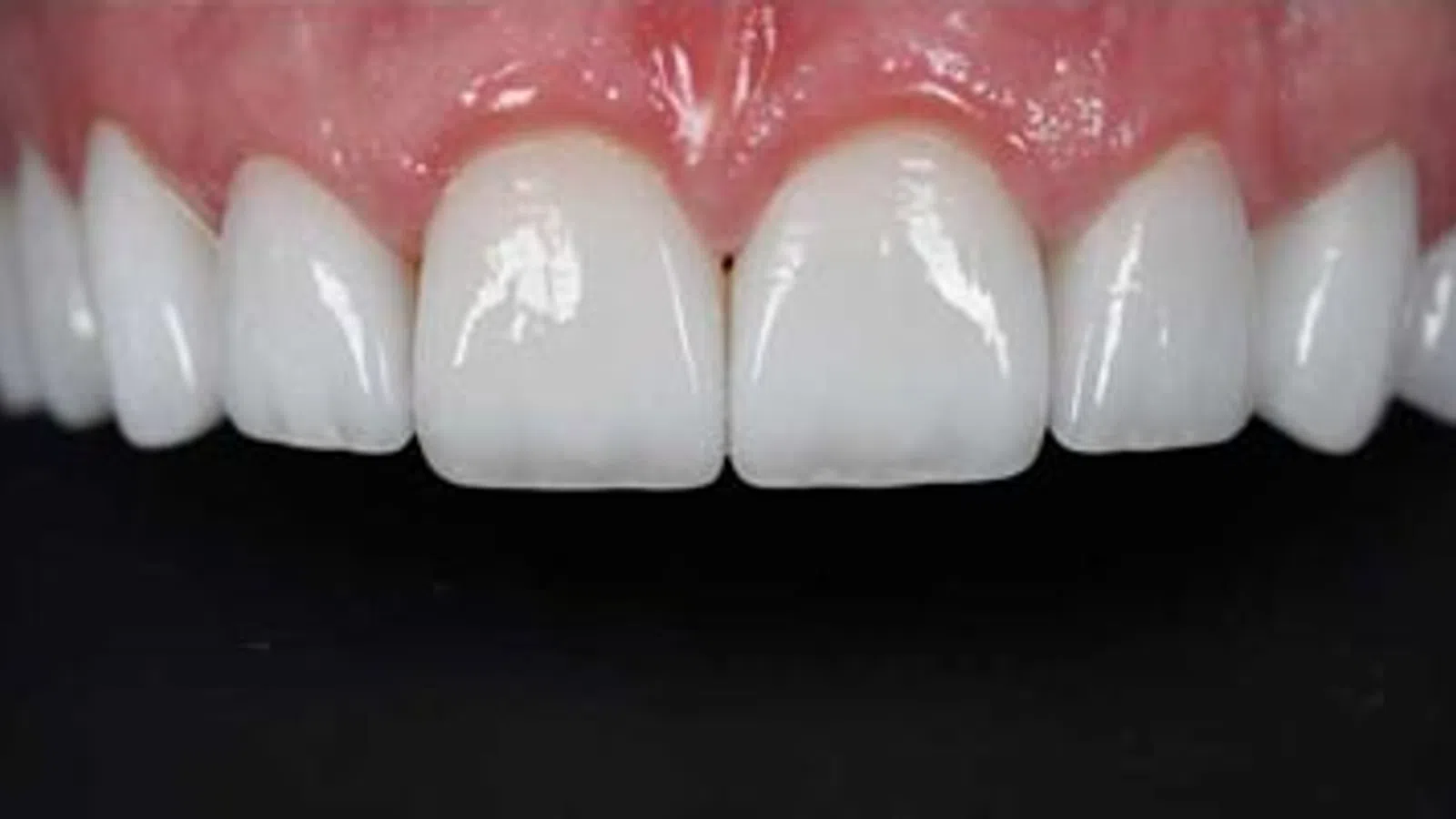 Close-up of a set of clean, white, evenly spaced upper front teeth with healthy pink gums.