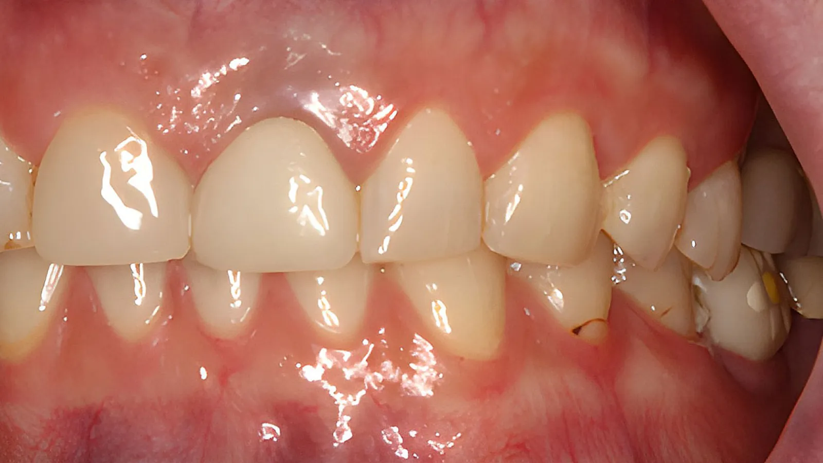 Close-up of teeth showing dental crowding with overlapping and misaligned teeth in the lower jaw.