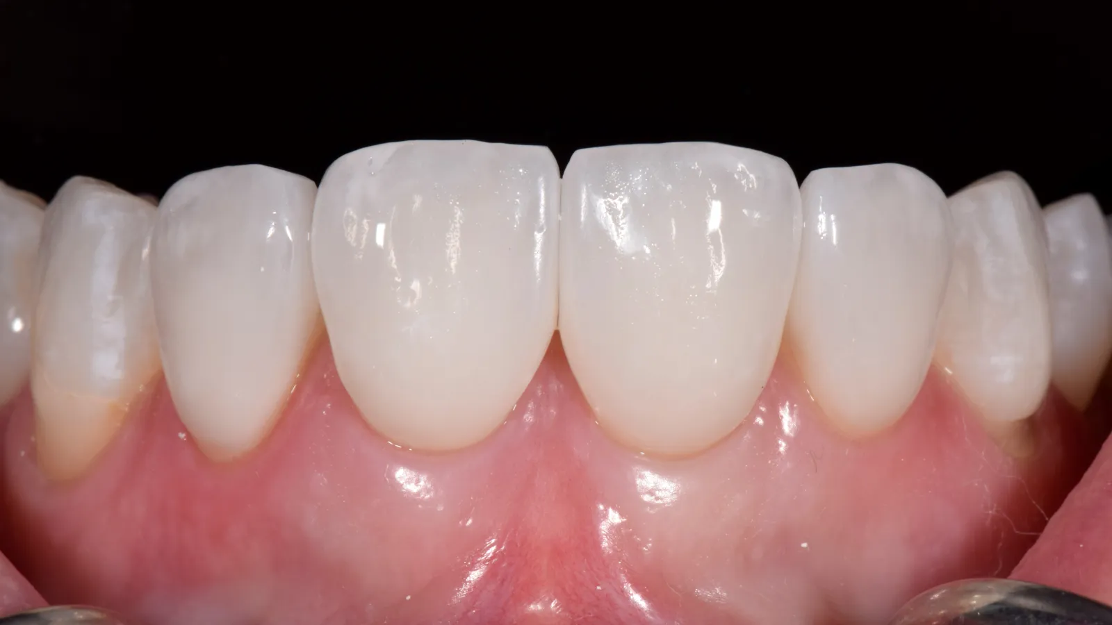 Close-up of healthy upper front teeth and gums with dental retractors exposing the gums and teeth.