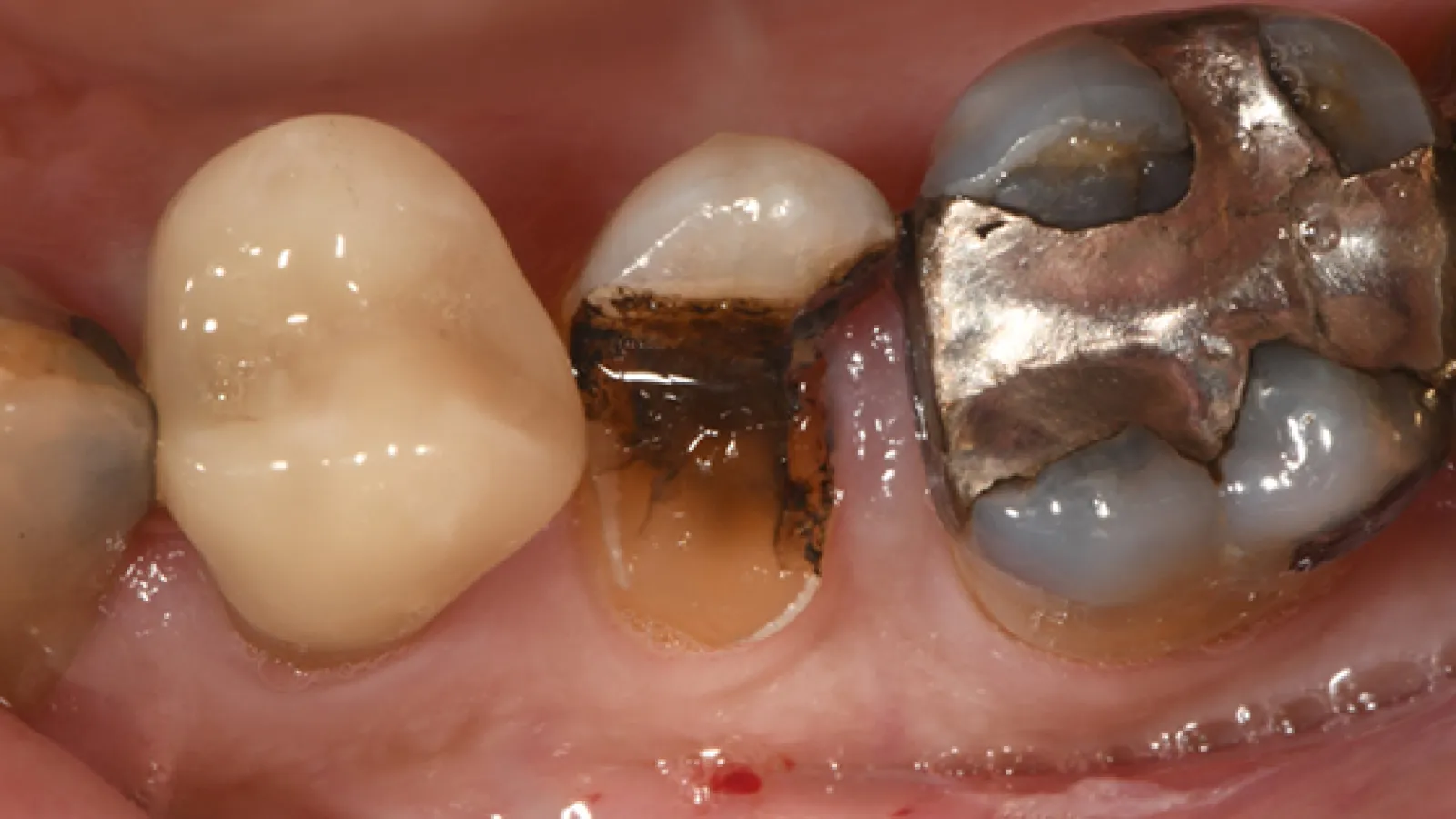 Close-up of dental decay and fillings on molars showing a cavity, metal filling, and tooth restoration.