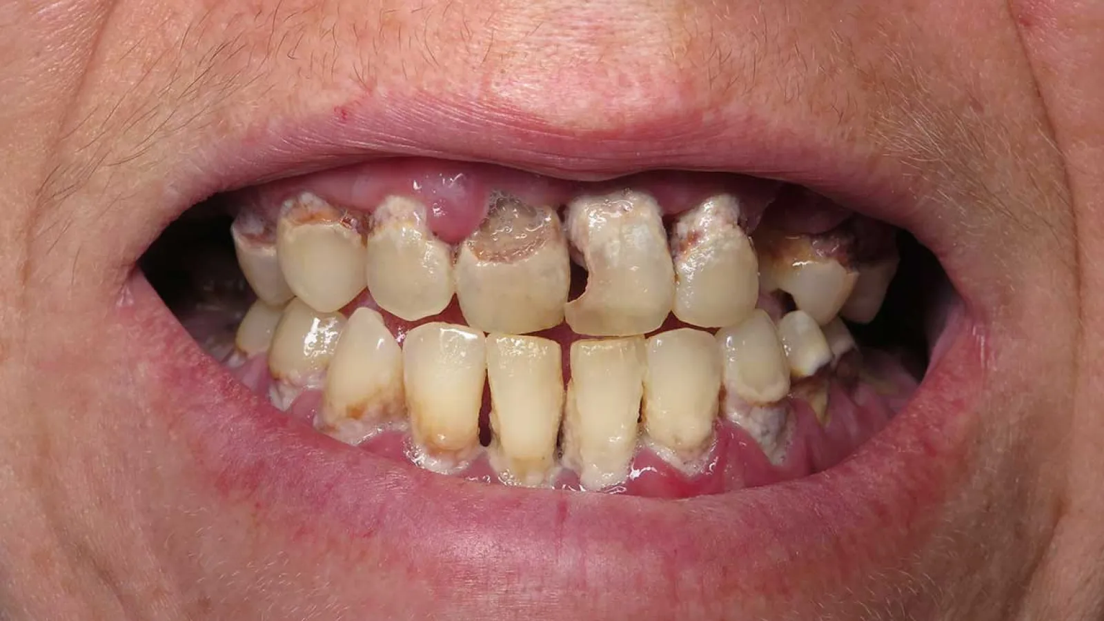 Close-up of severely decayed and discolored upper and lower teeth with significant plaque and gum issues.