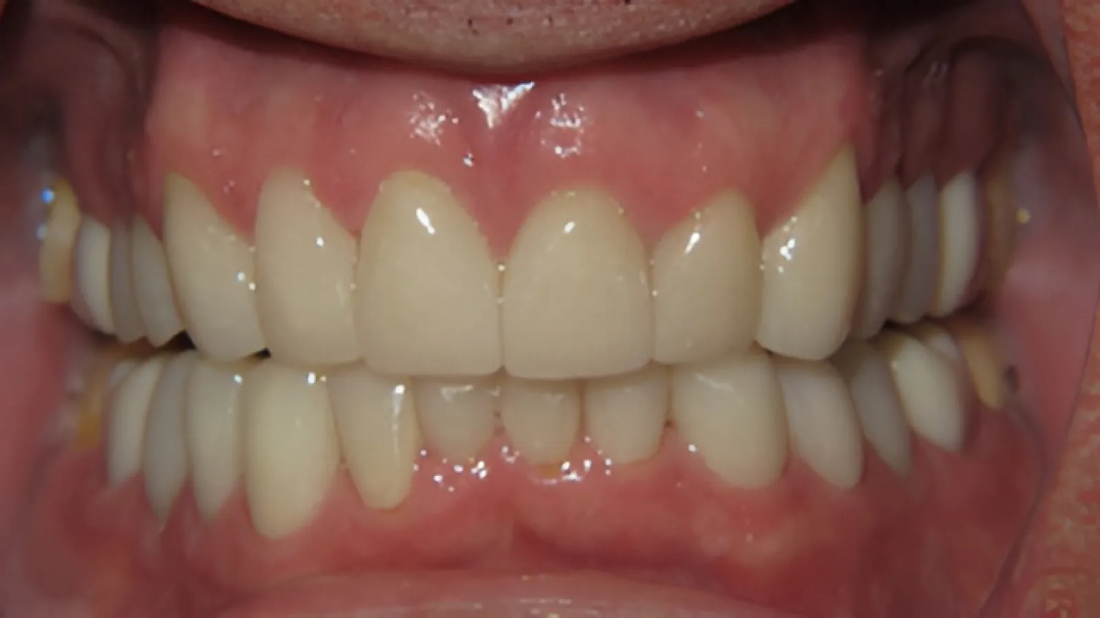 Close-up of dental veneers on upper and lower teeth showing natural color and alignment with gums.