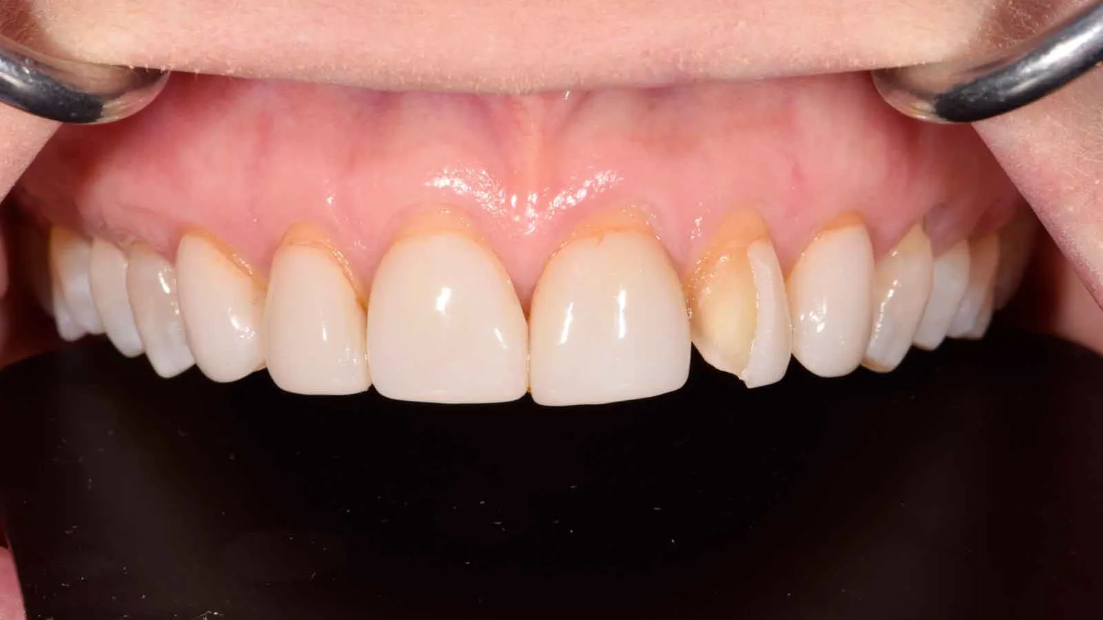 Close-up of upper front teeth showing dental plaque and gingivitis with mouth retractor in place