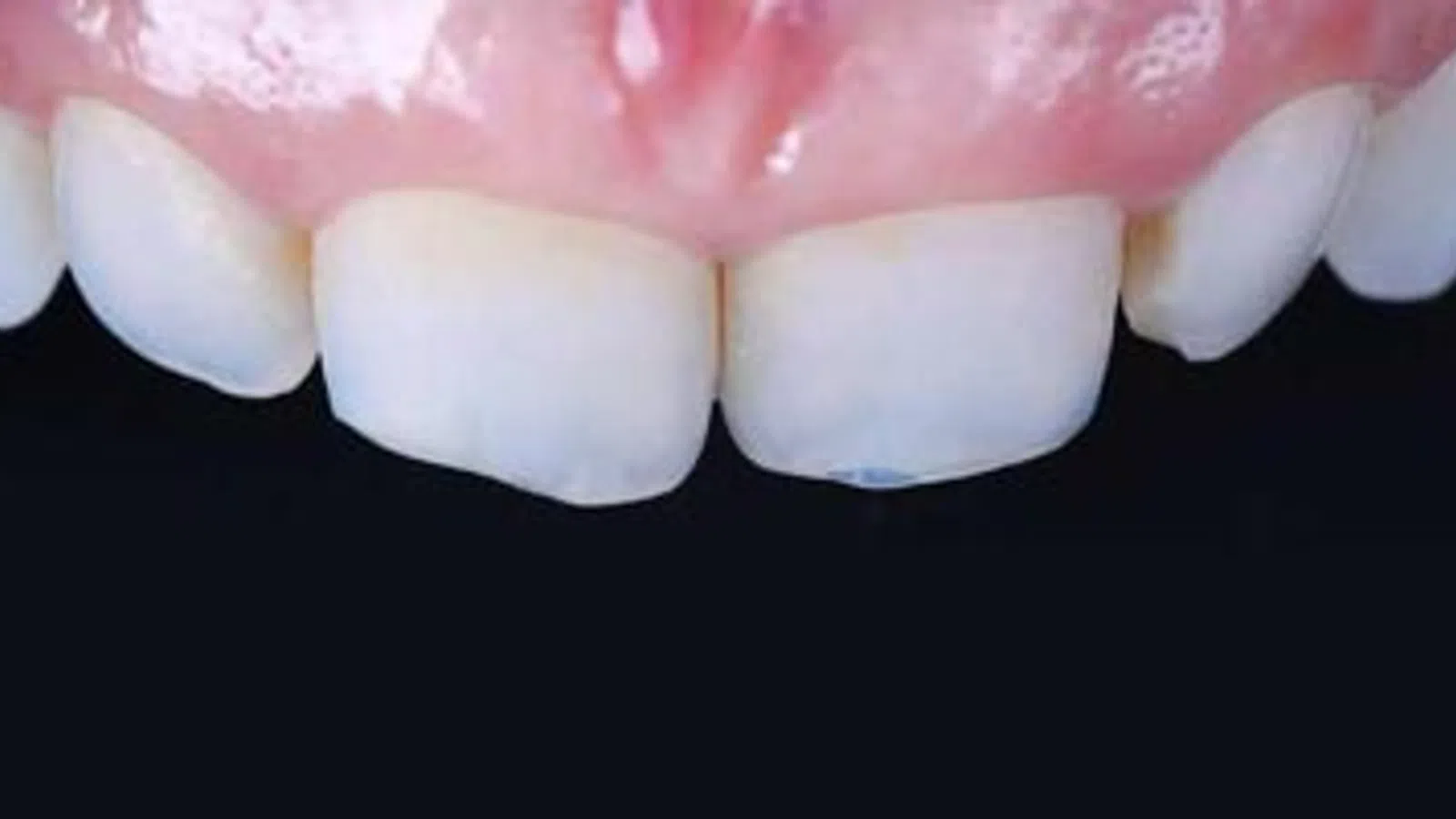 Close-up of upper front teeth with a chipped incisor and healthy pink gums against a black background