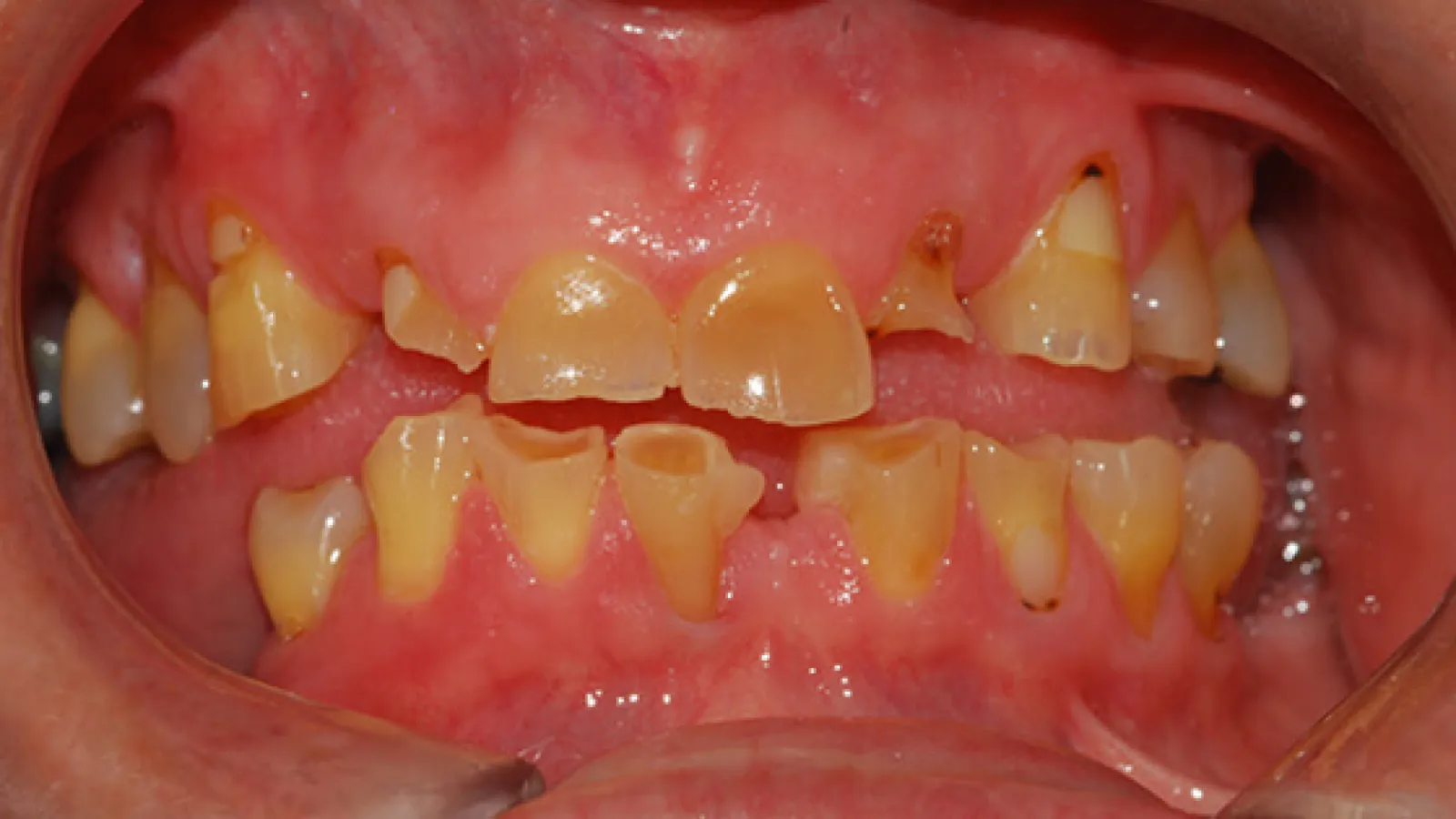 Close-up of severely decayed and discolored human teeth with chipped edges and inflamed gums.