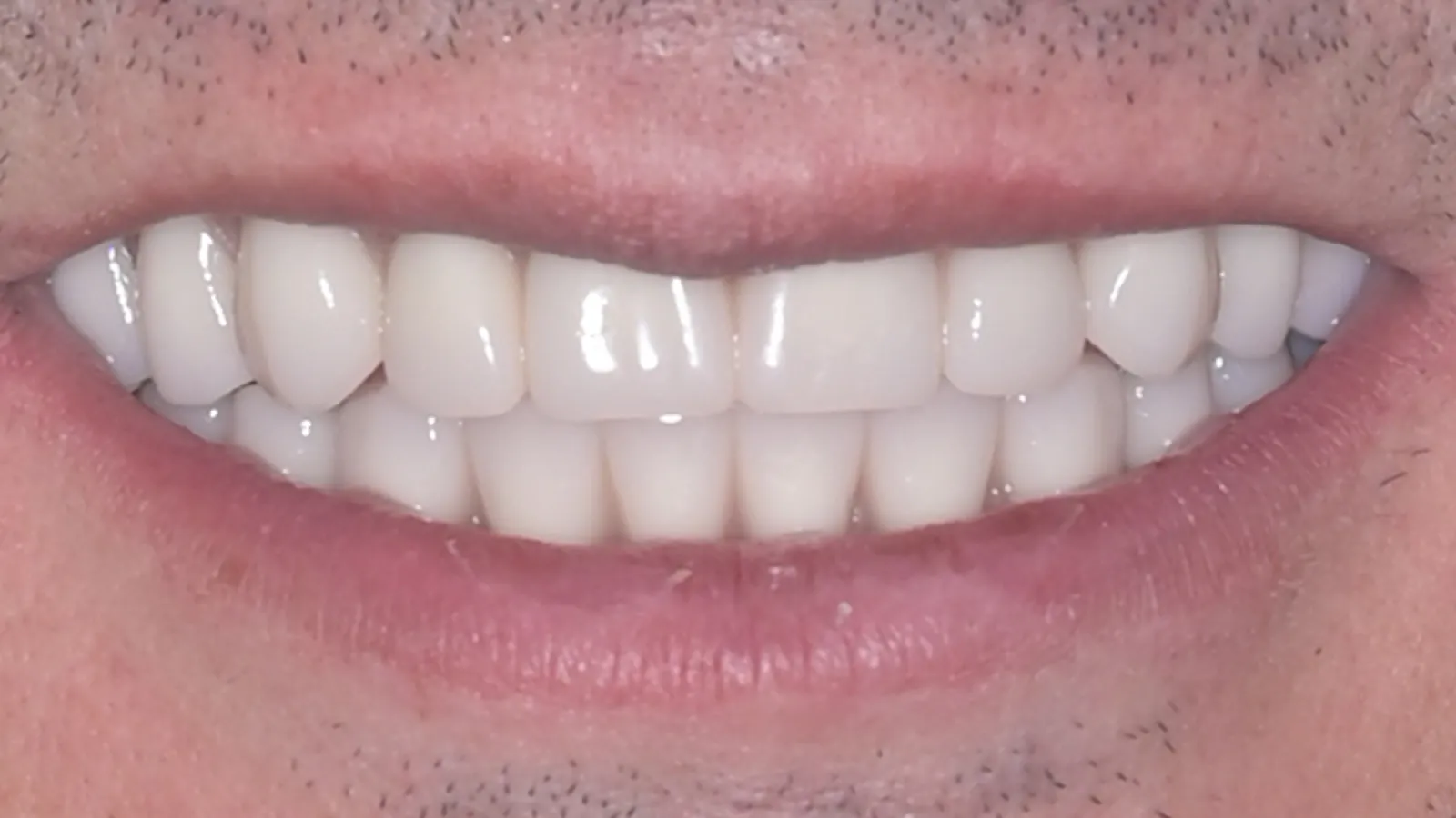 Close-up of a smiling mouth showing straight, white teeth and natural lip texture.