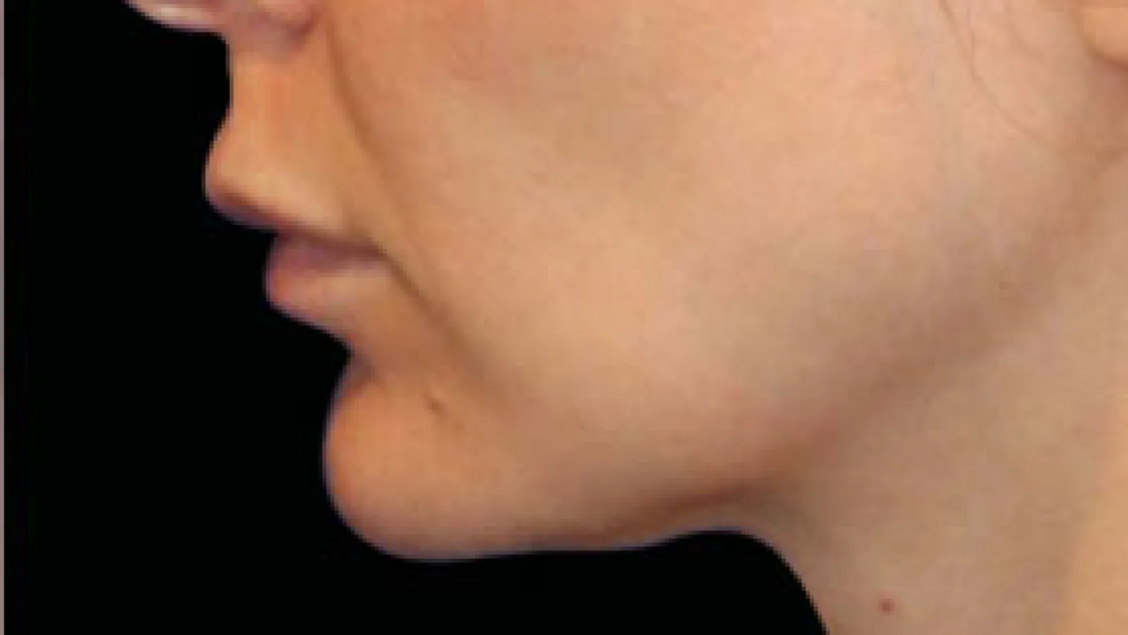 Close-up side view of a person's jawline and chin against a black background.