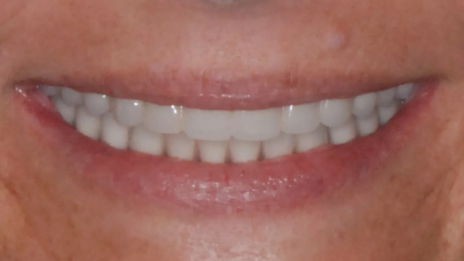 Close-up of a smiling mouth showing clean, white teeth and natural lip texture under soft light