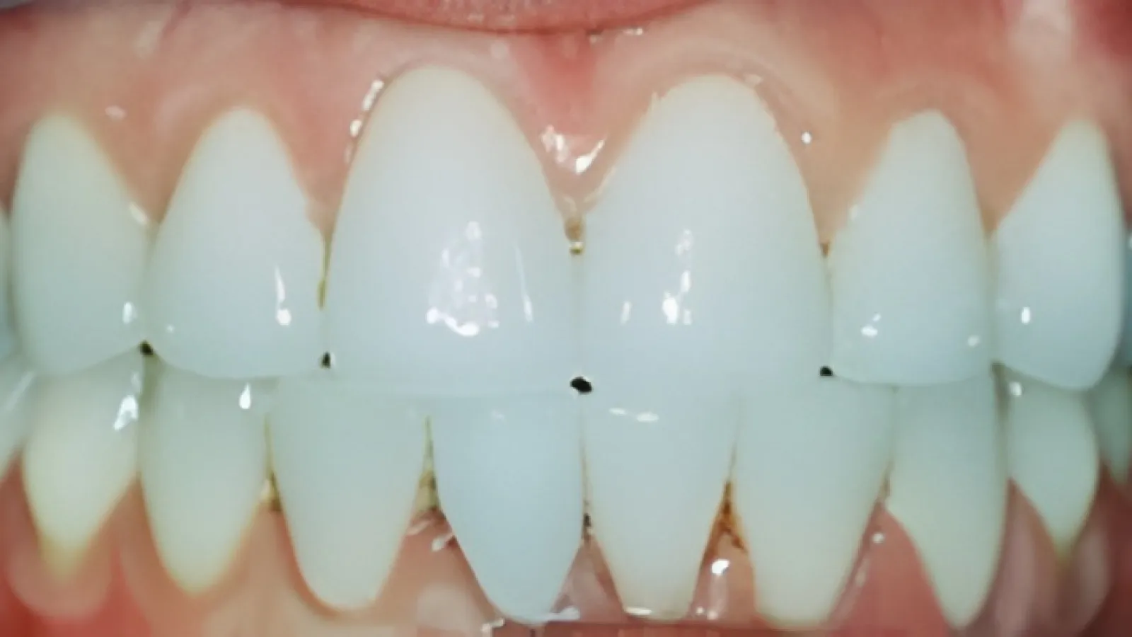 Close-up of clean, healthy white teeth and gums showing dental alignment and natural shine.