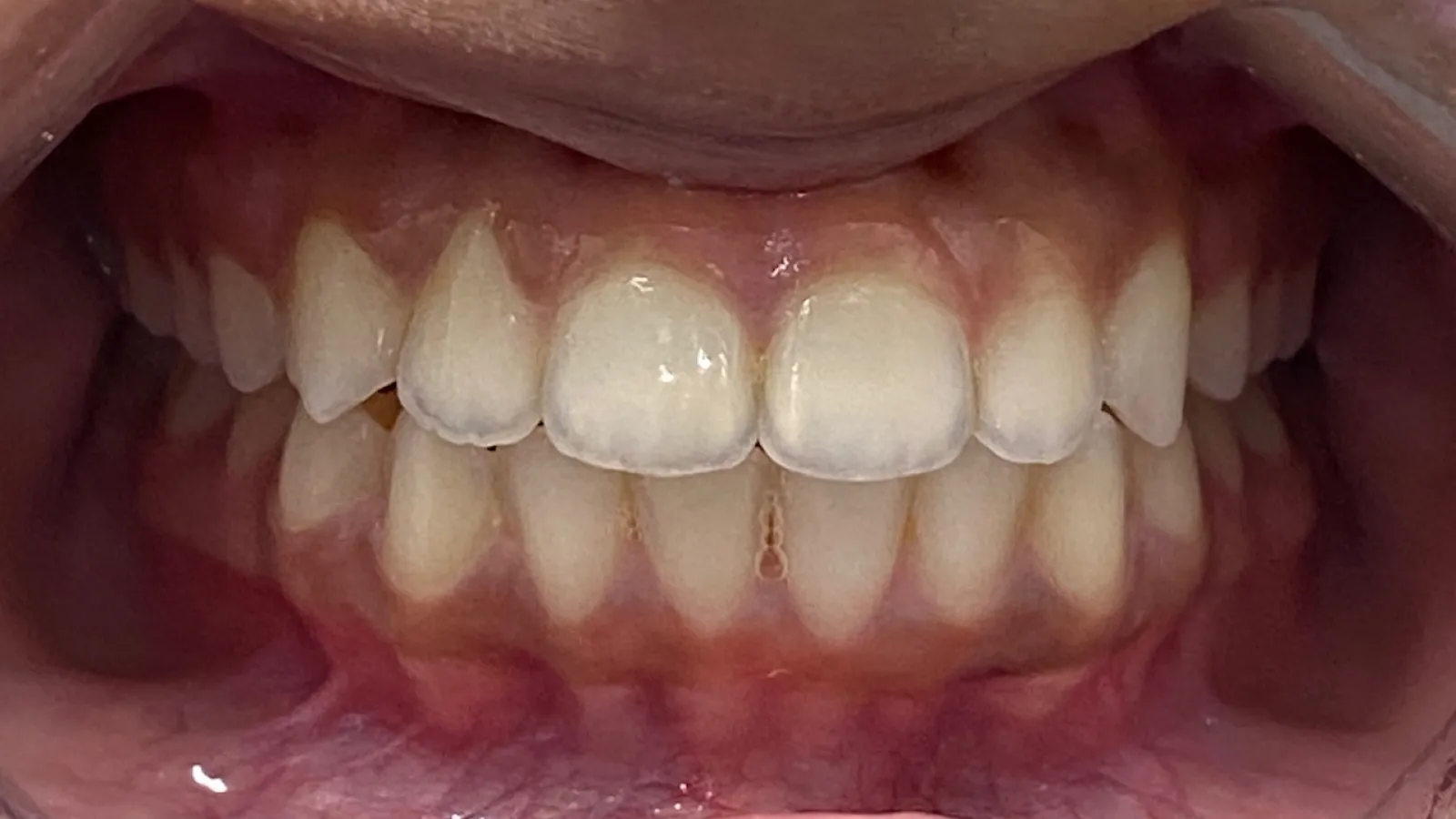 Close-up of a person's teeth showing natural alignment and gum health with visible upper and lower teeth.