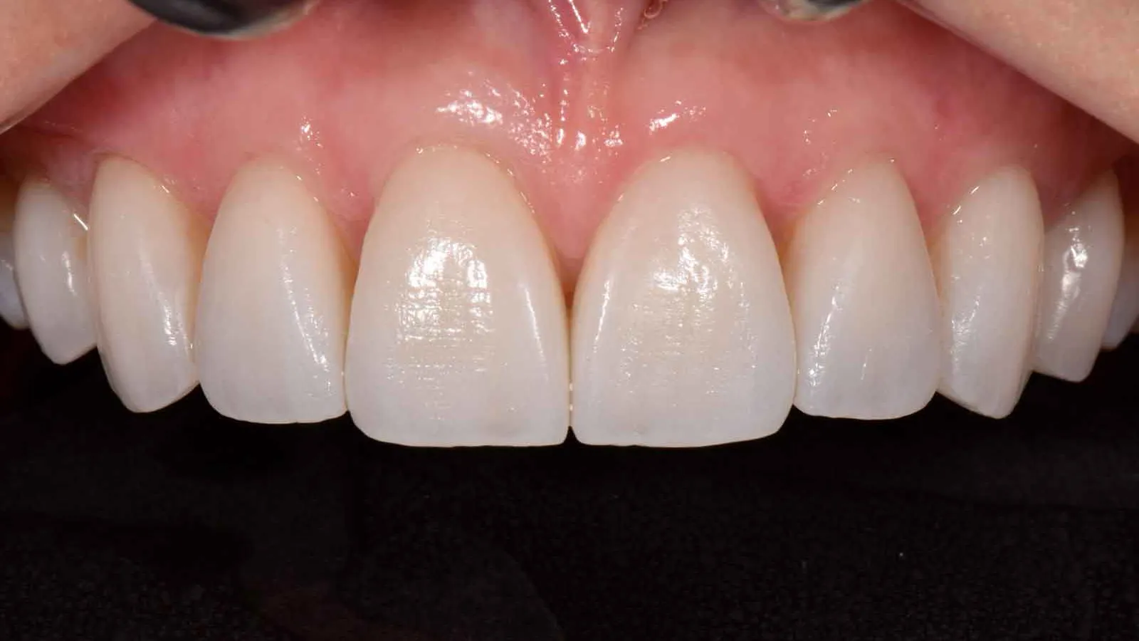 Close-up of healthy upper front teeth with clean gums and natural shine under dental examination.