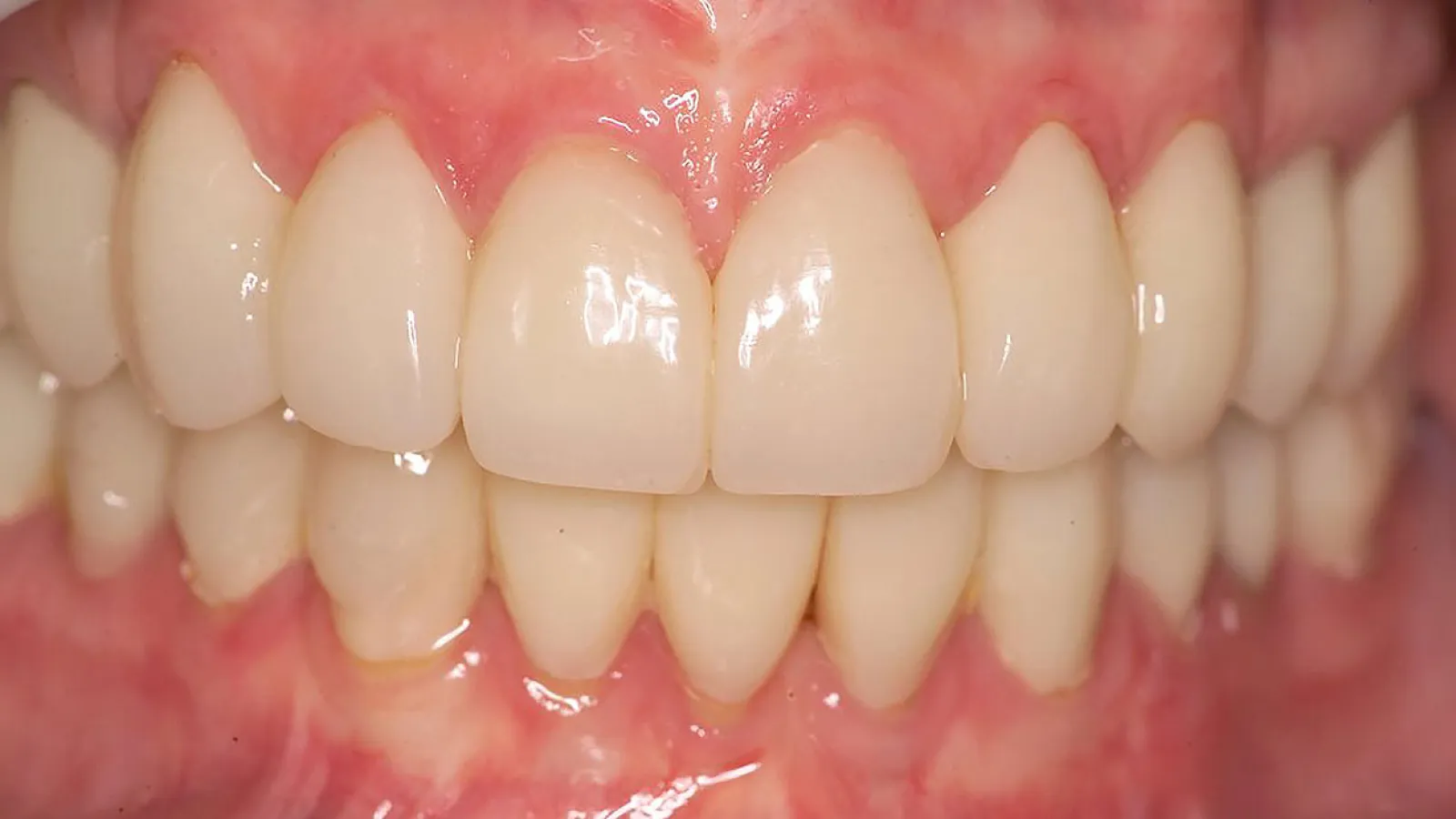 Close-up of healthy teeth with bright enamel and pink gums, showcasing dental health and hygiene.