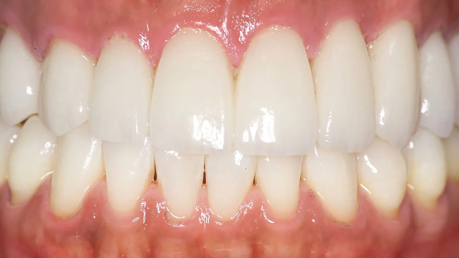 Close-up view of healthy, white teeth displaying good dental hygiene with shiny enamel.