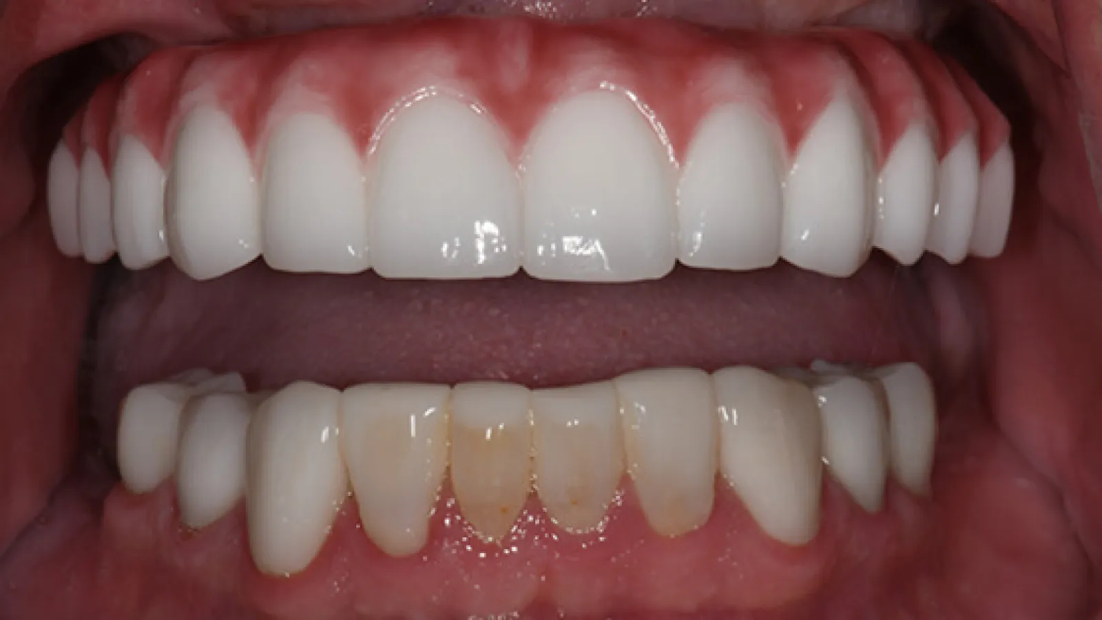 Close-up of upper dental veneers showcasing bright white teeth above natural, stained lower teeth.