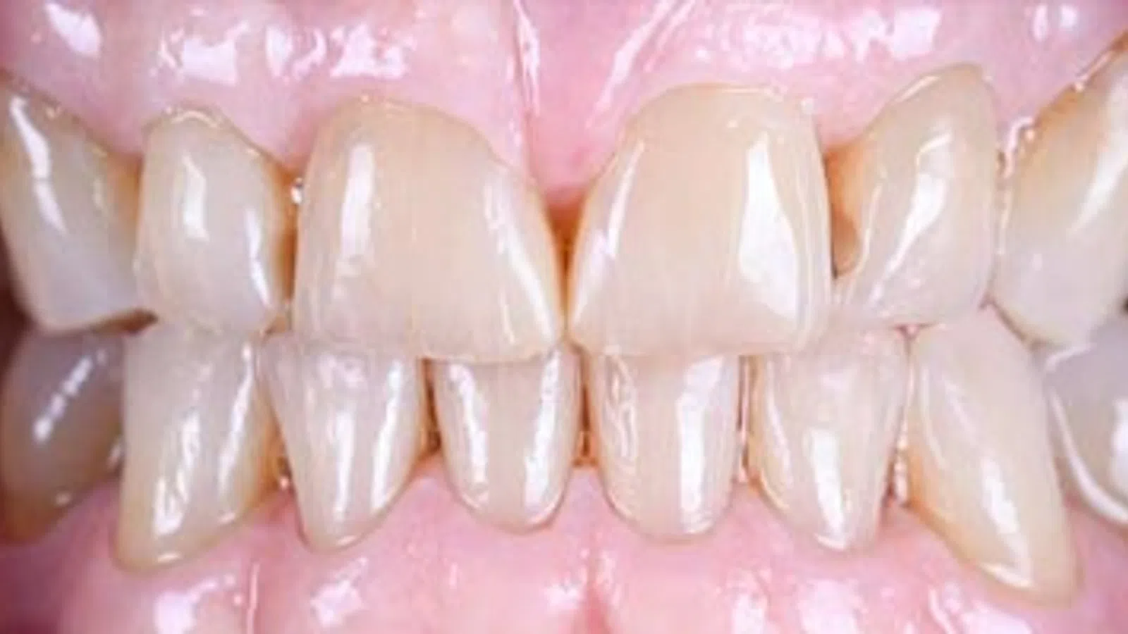 Close-up of misaligned human teeth showing crowding and overlapping in upper and lower jaws.