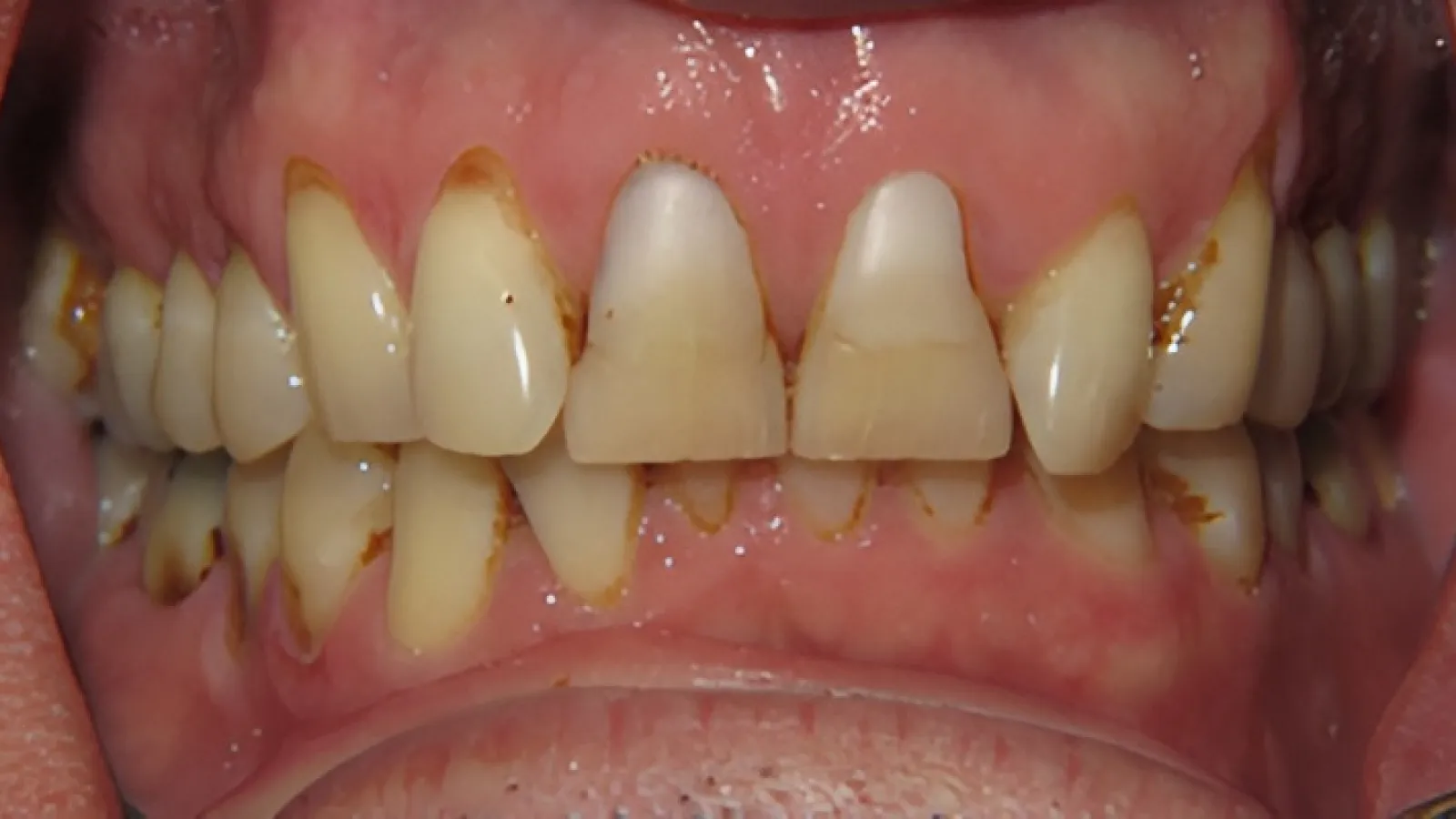 Close-up of upper and lower teeth showing severe plaque, tartar buildup, and discoloration on the front teeth.