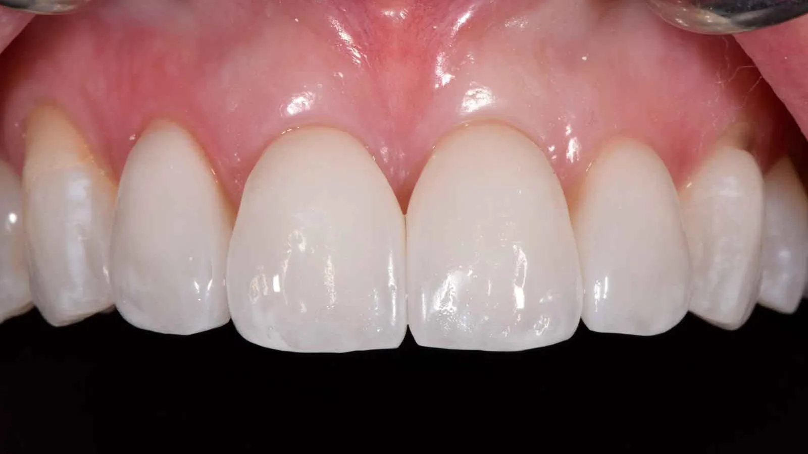 Close-up of healthy upper front teeth with natural gums and clean white enamel against black background.