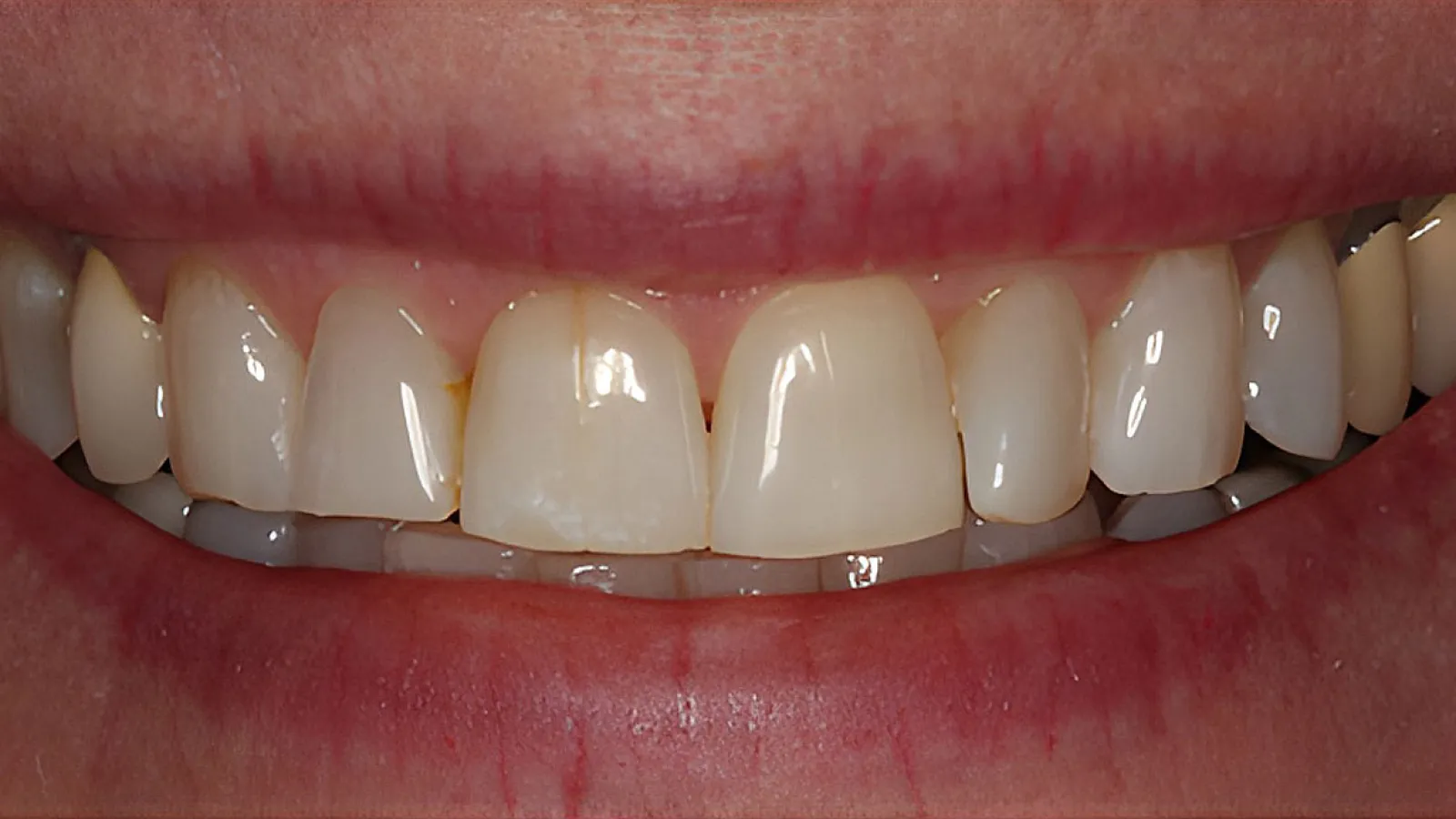 Close-up of a smile showing natural teeth with slight discoloration and a small chip on a front tooth.