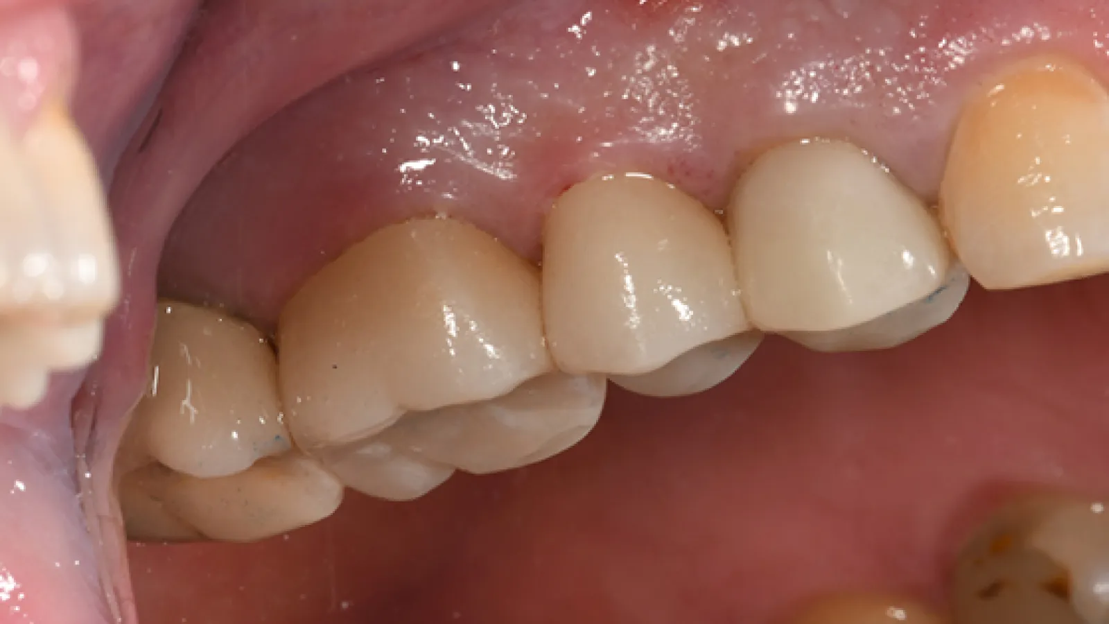 Close-up of molar teeth with dental crowns on lower jaw near gum line under bright light.