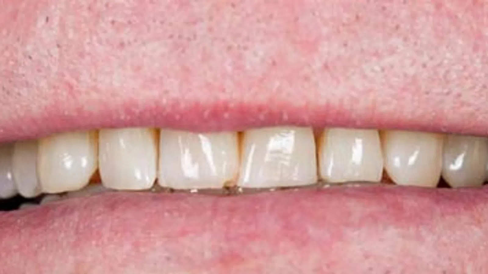 Close-up of upper front teeth with visible plaque and discoloration along the gum line.