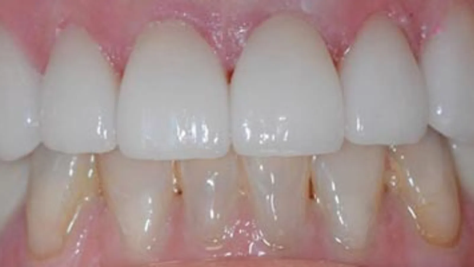 Close-up of upper and lower teeth showing dental alignment and gum health with slight discoloration on lower teeth.