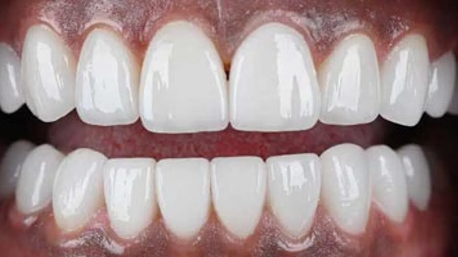 Close-up of bright white human teeth and gums with perfect dental alignment and healthy appearance