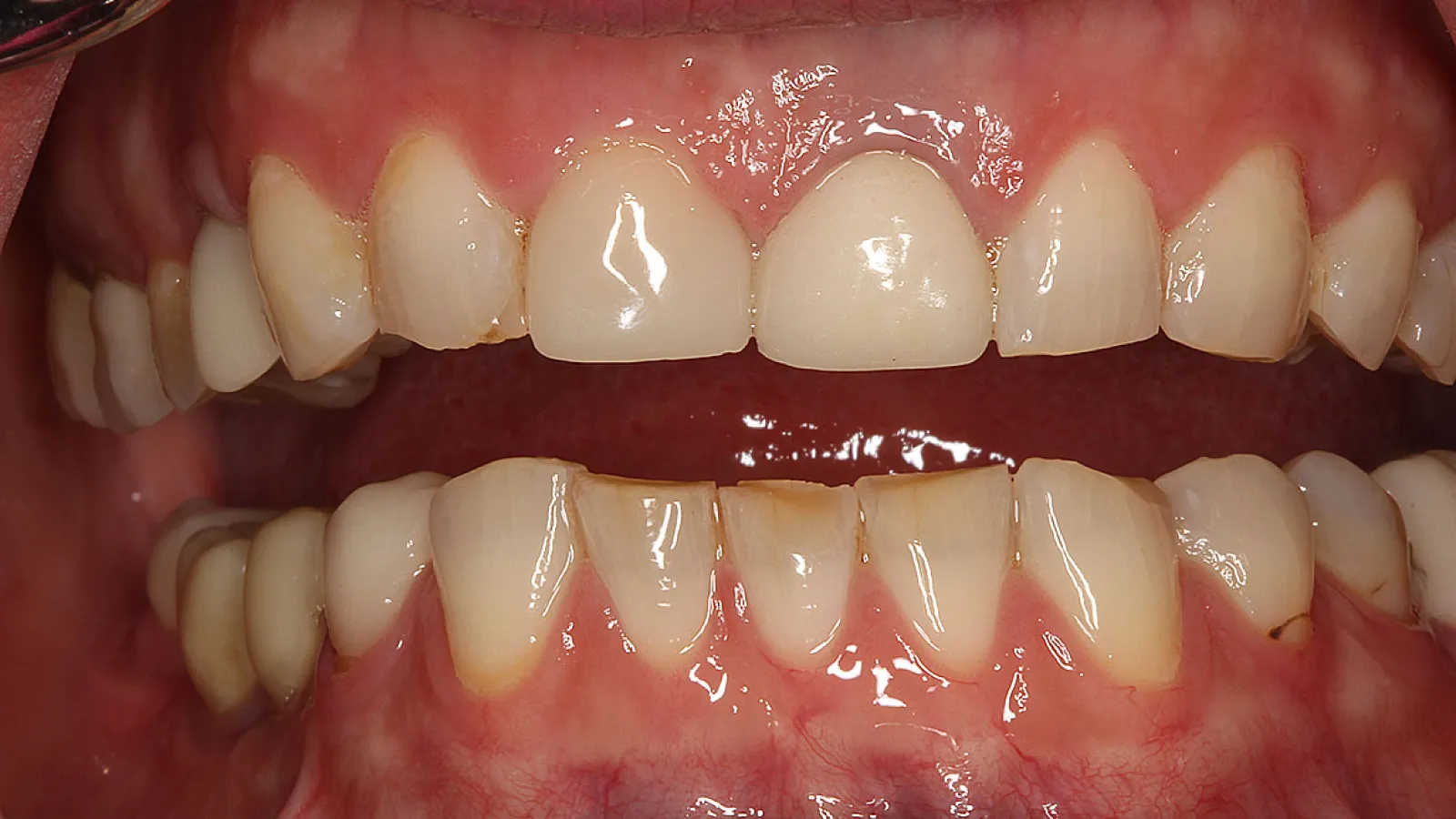 Close-up of mouth showing teeth with discoloration, gaps, and uneven alignment on upper and lower jaws.