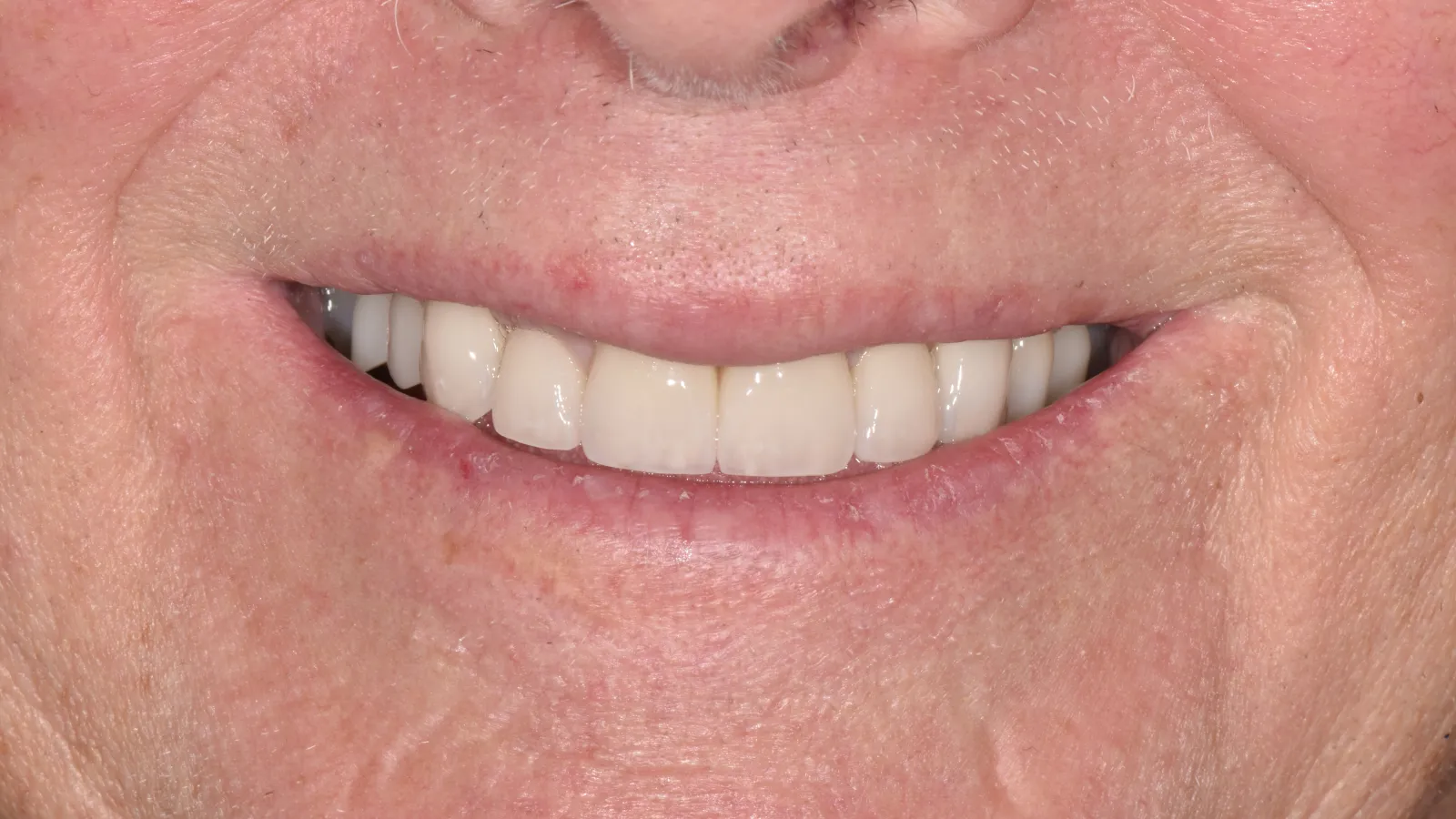 Close-up of a senior person's smile with white teeth and natural skin texture around lips and nose.