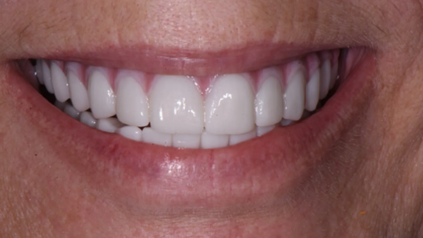 Close-up of a person's bright white smile showing clean, healthy teeth and pink gums.