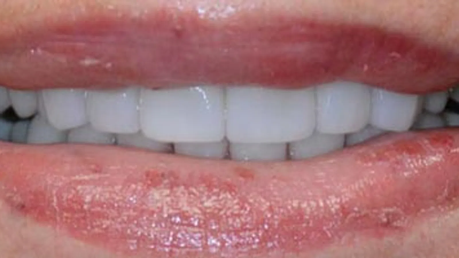 Close-up of lips with chapped skin and white teeth visible in a slight smile.