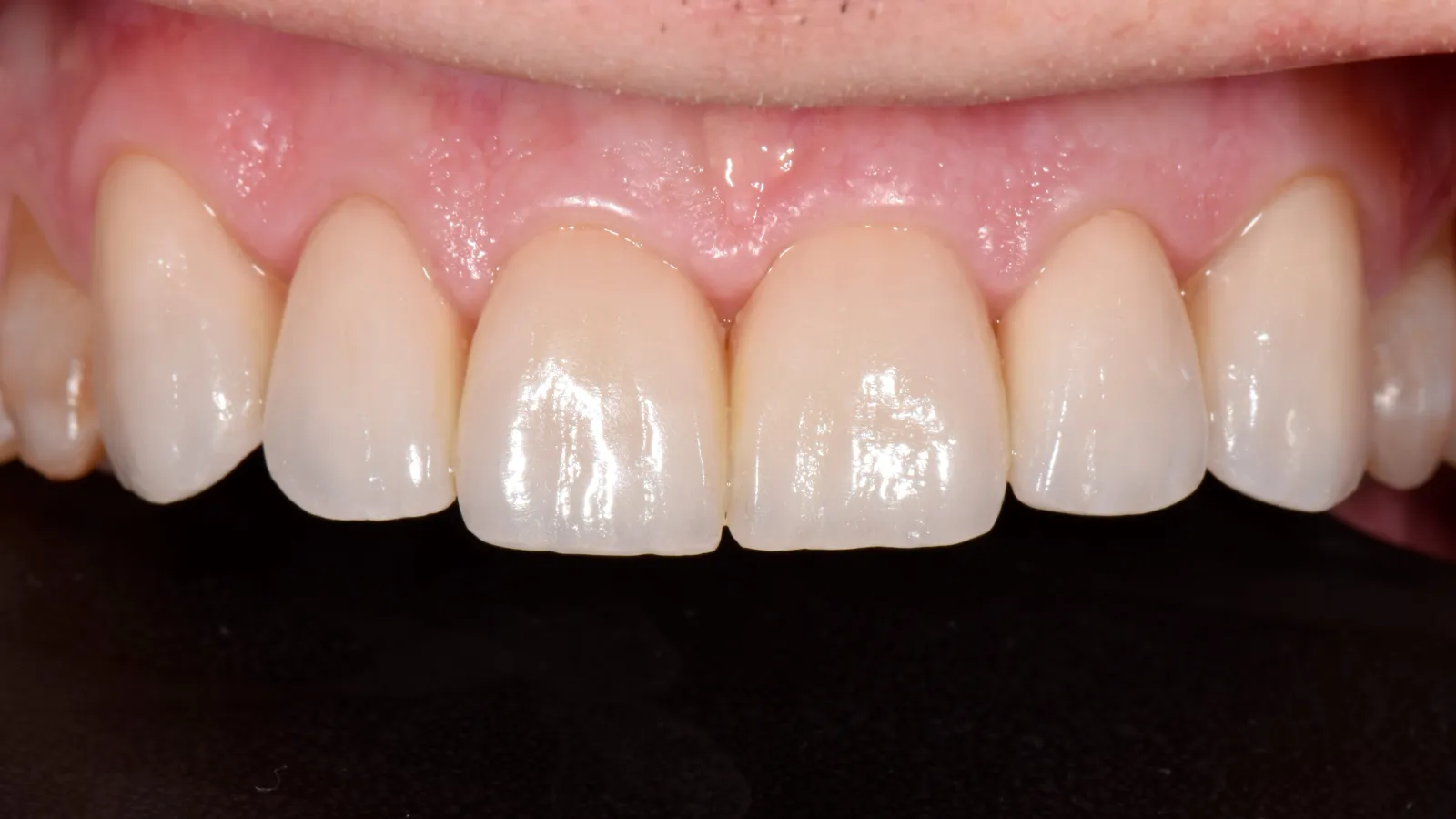 Close-up of clean, healthy upper front teeth and gums with natural shine and no visible dental issues.