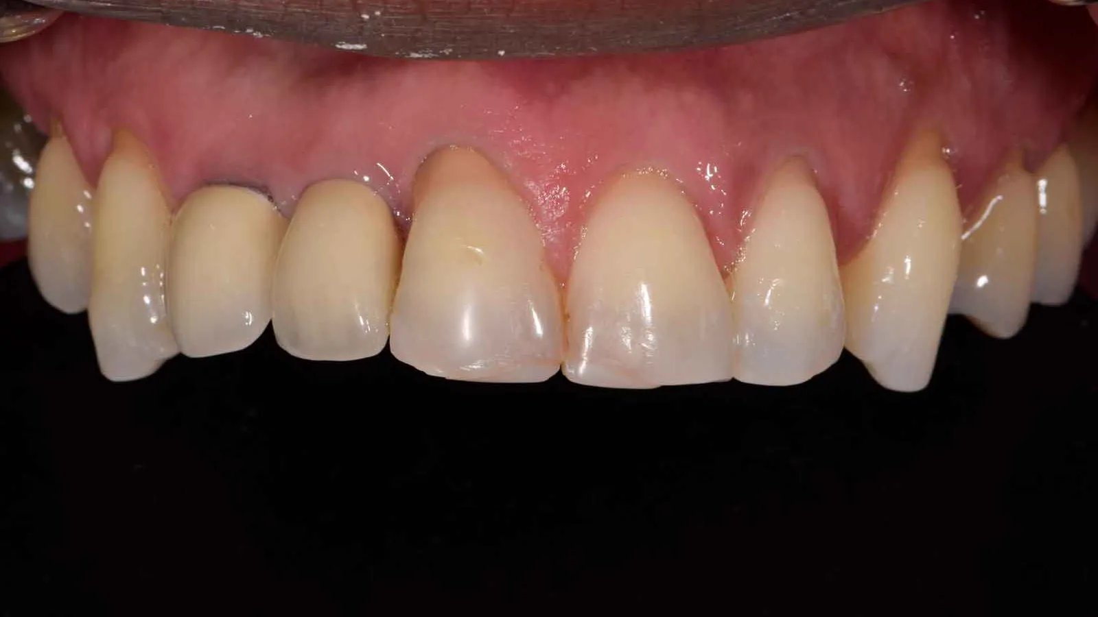 Close-up of upper front teeth showing natural discoloration and uneven edges against black background